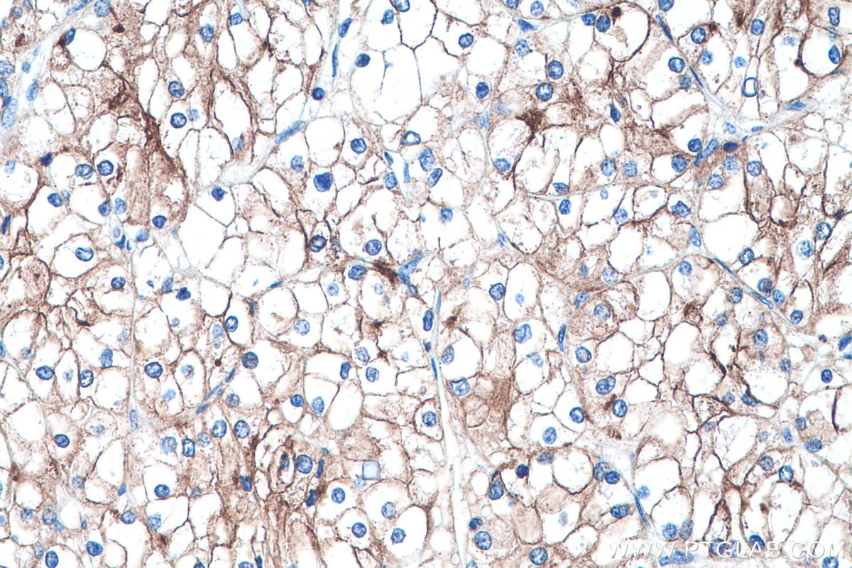 Immunohistochemical analysis of paraffin-embedded human renal cell carcinoma tissue slide using KHC0386 (CD10 IHC Kit).