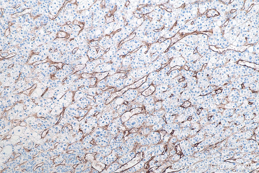 Immunohistochemical analysis of paraffin-embedded human liver cancer tissue slide using KHC0024 (Endoglin/CD105 IHC Kit).