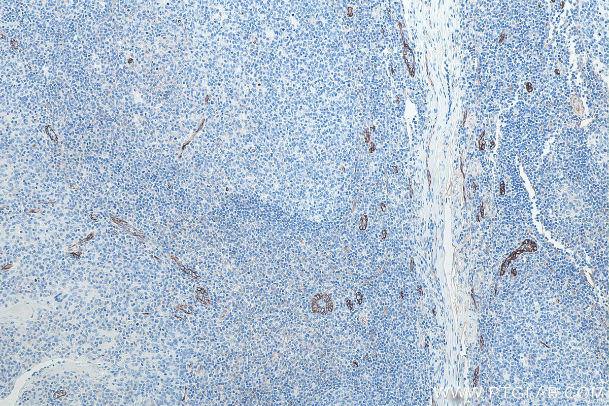 Immunohistochemical analysis of paraffin-embedded human tonsillitis tissue slide using KHC0024 (CD105 IHC Kit).