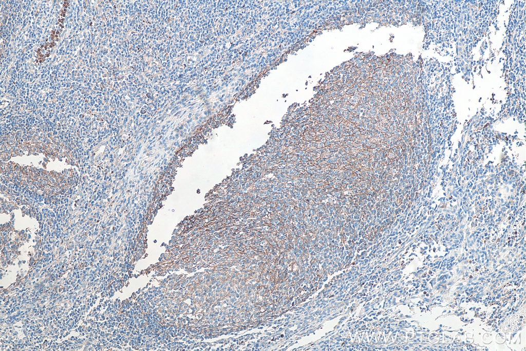 Immunohistochemical analysis of paraffin-embedded human tonsillitis tissue slide using KHC0027 (CD11B IHC Kit).