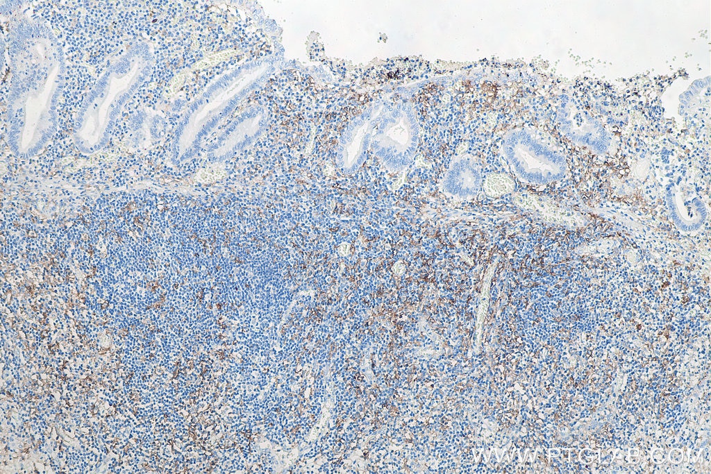 Immunohistochemical analysis of paraffin-embedded human appendicitis tissue slide using KHC0017 (CD11c IHC Kit).