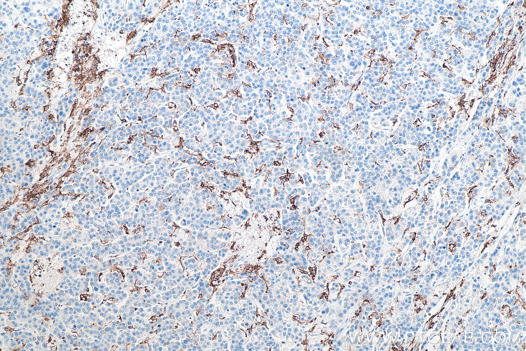 Immunohistochemical analysis of paraffin-embedded human liver cancer tissue slide using KHC0017 (CD11c IHC Kit).