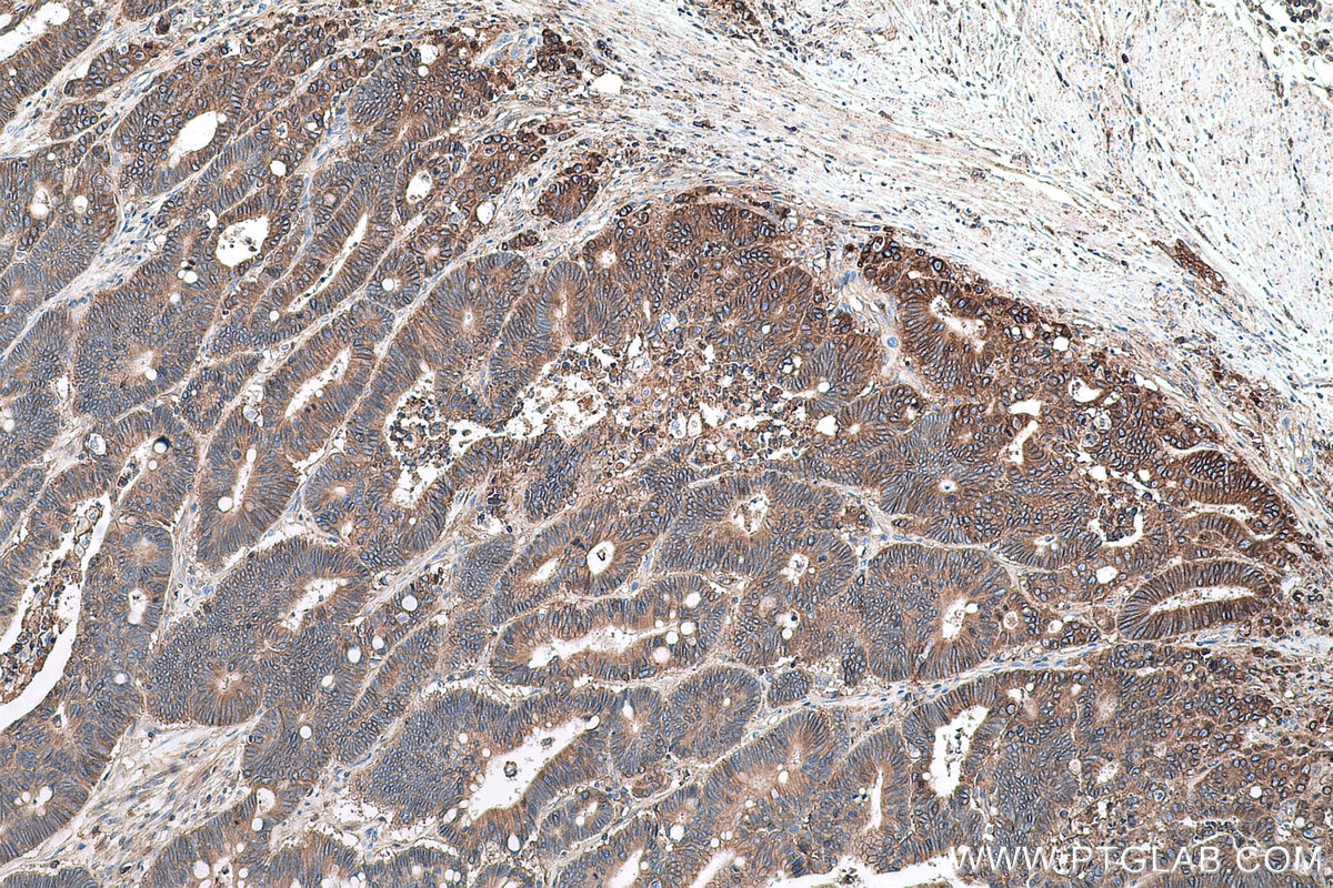 Immunohistochemical analysis of paraffin-embedded human colon cancer tissue slide using KHC0607 (CD147/BSG IHC Kit).