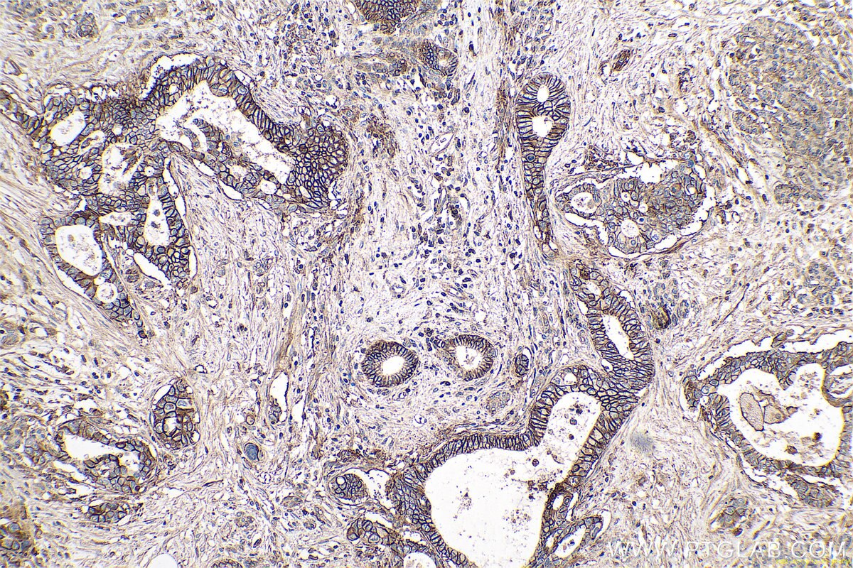 Immunohistochemical analysis of paraffin-embedded human pancreas cancer tissue slide using KHC0607 (CD147/BSG IHC Kit).