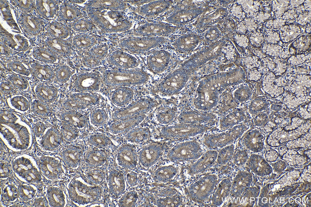 Immunohistochemical analysis of paraffin-embedded human stomach cancer tissue slide using KHC1343 (CD151 IHC Kit).