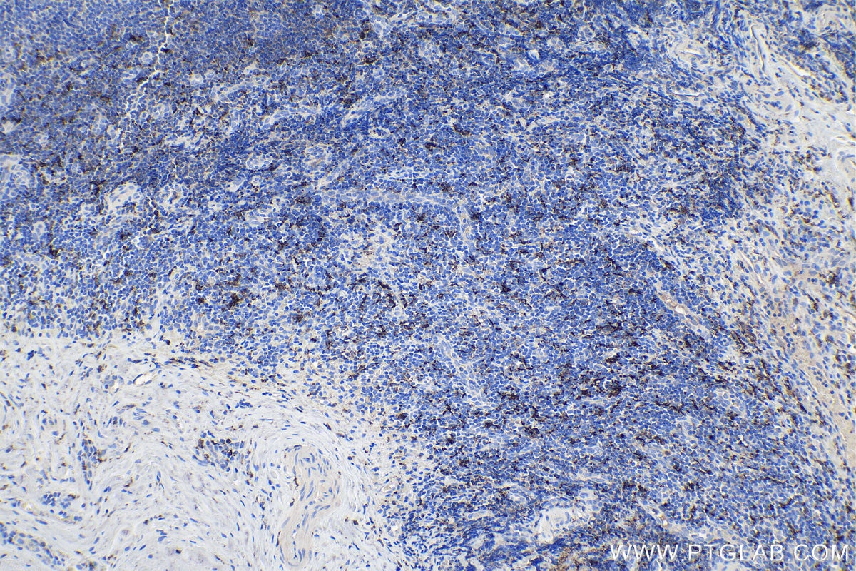 Immunohistochemical analysis of paraffin-embedded human tonsillitis tissue slide using KHC0942 (CD163 IHC Kit).