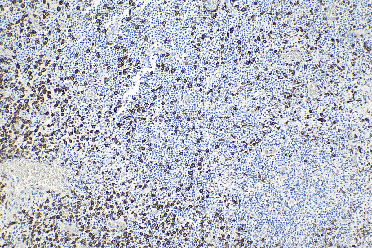 Immunohistochemical analysis of paraffin-embedded human colon cancer tissue slide using KHC0942 (CD163 IHC Kit).