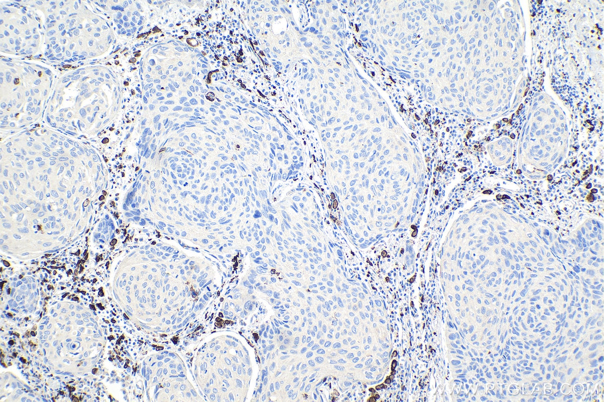 Immunohistochemical analysis of paraffin-embedded human lung cancer tissue slide using KHC0942 (CD163 IHC Kit).