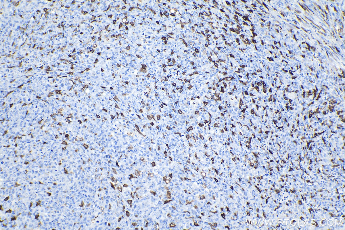 Immunohistochemical analysis of paraffin-embedded human lymphoma tissue slide using KHC0942 (CD163 IHC Kit).