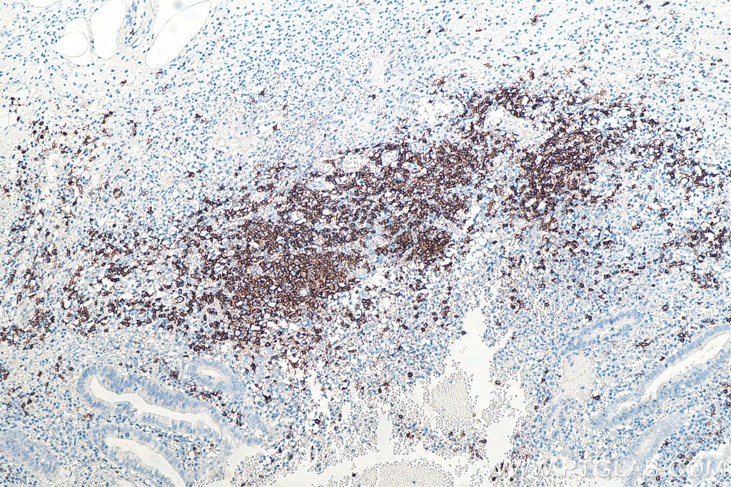 Immunohistochemical analysis of paraffin-embedded human appendicitis tissue slide using KHC0018 (CD20 IHC Kit).