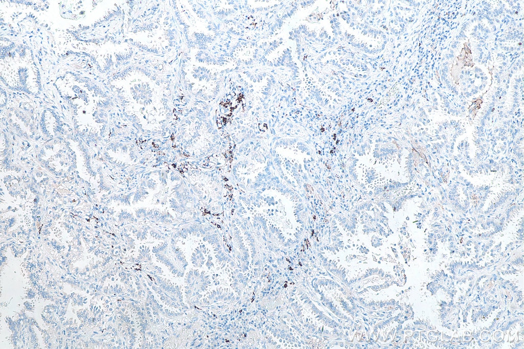 Immunohistochemical analysis of paraffin-embedded human lung cancer tissue slide using KHC0007 (CD206 IHC Kit).