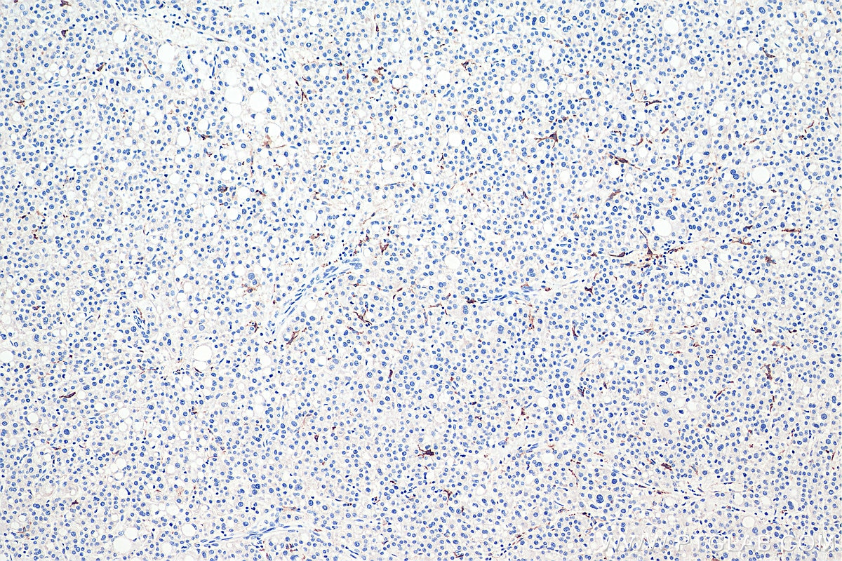 Immunohistochemical analysis of paraffin-embedded human liver cancer tissue slide using KHC0007 (CD206 IHC Kit).
