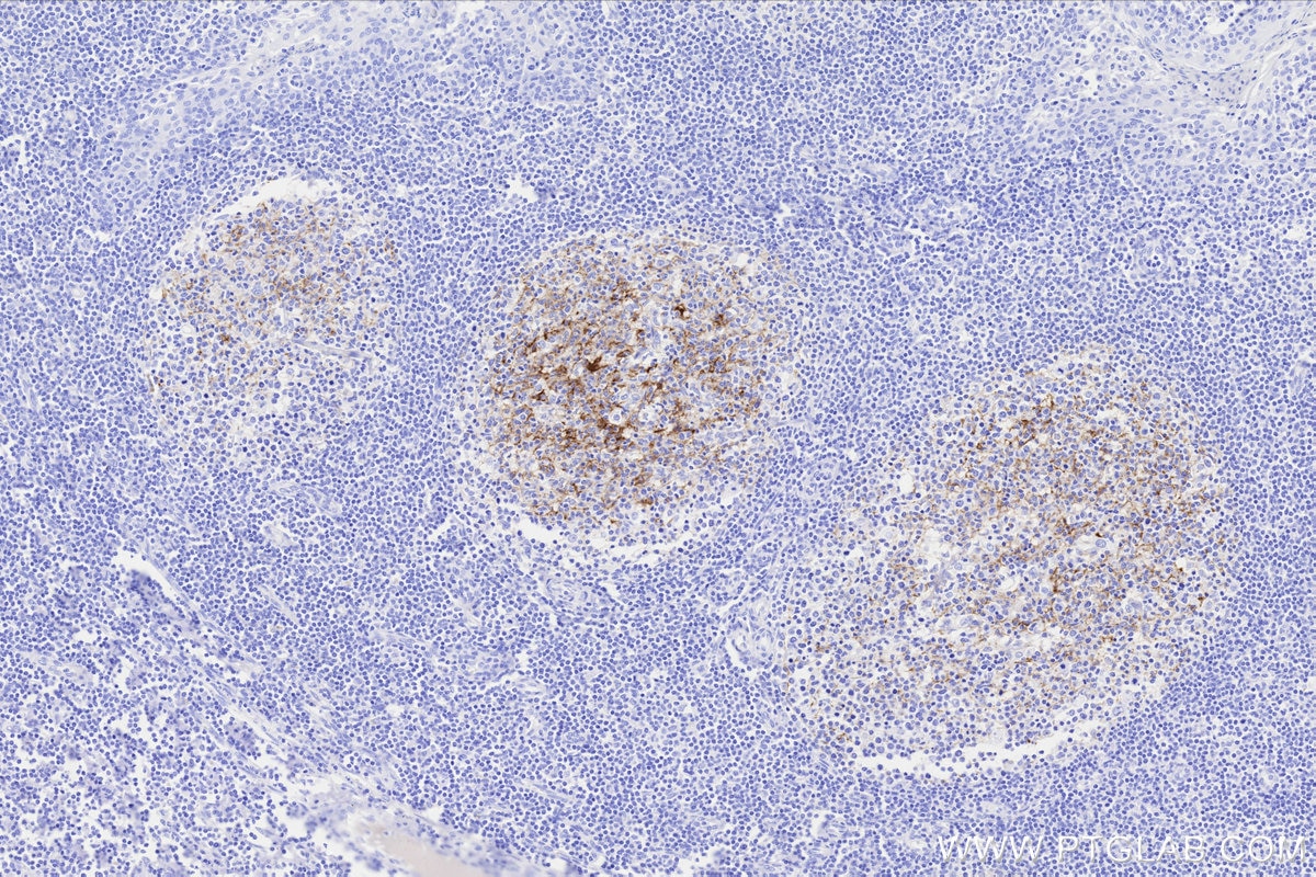 Immunohistochemical analysis of paraffin-embedded human tonsillitis tissue slide using KHC3310 (CD21 IHC Kit).