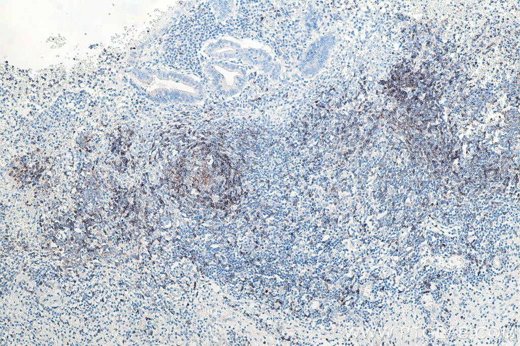 Immunohistochemical analysis of paraffin-embedded human appendicitis tissue slide using KHC0019 (CD22 IHC Kit).