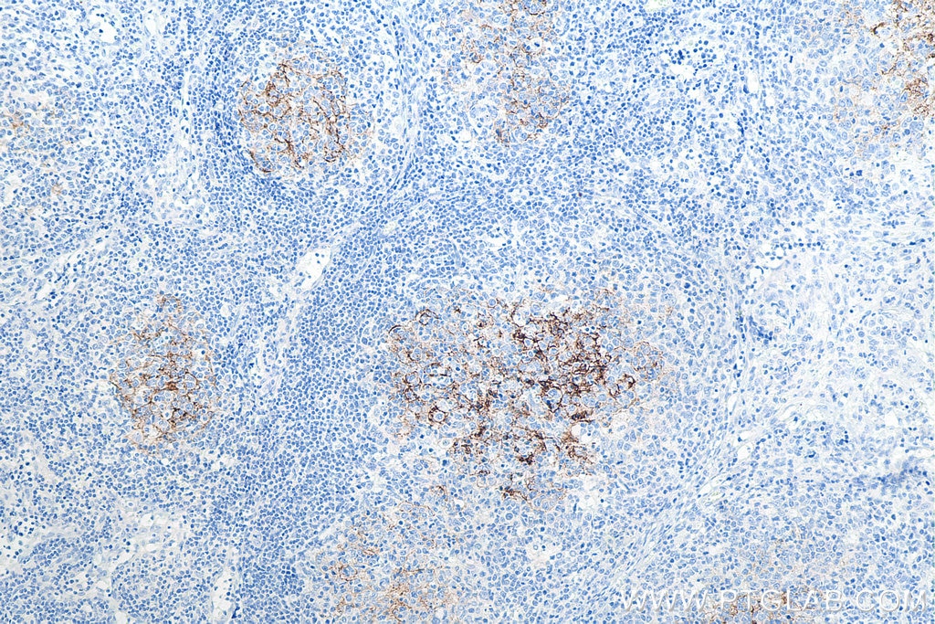 Immunohistochemical analysis of paraffin-embedded human lymphoma tissue slide using KHC0021 (CD23 IHC Kit).