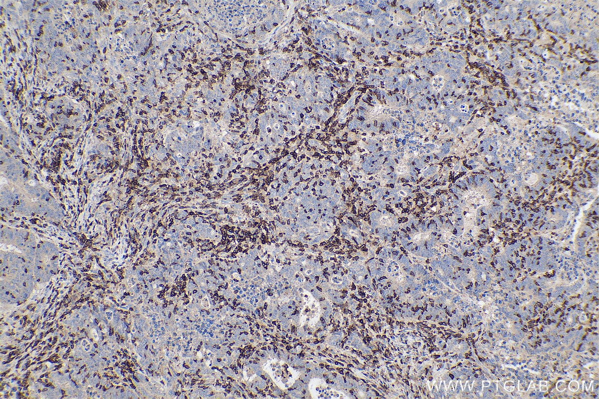 Immunohistochemical analysis of paraffin-embedded human colon cancer tissue slide using KHC0608 (CD247 IHC Kit).