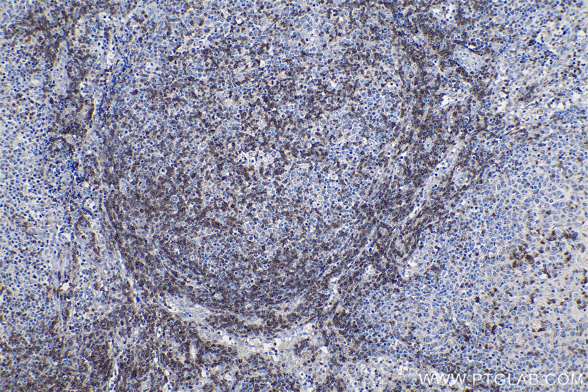 Immunohistochemical analysis of paraffin-embedded human lymphoma tissue slide using KHC0608 (CD247 IHC Kit).