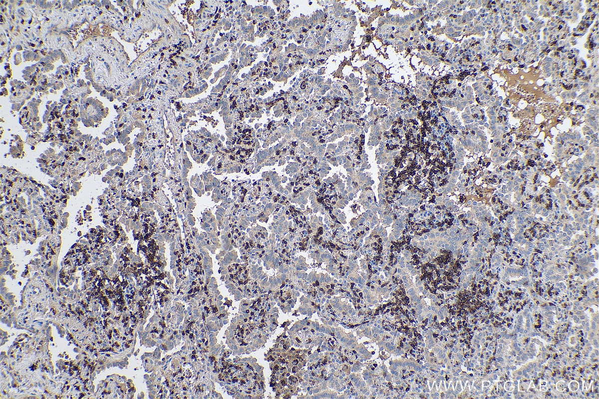 Immunohistochemical analysis of paraffin-embedded human lung cancer tissue slide using KHC0608 (CD247 IHC Kit).