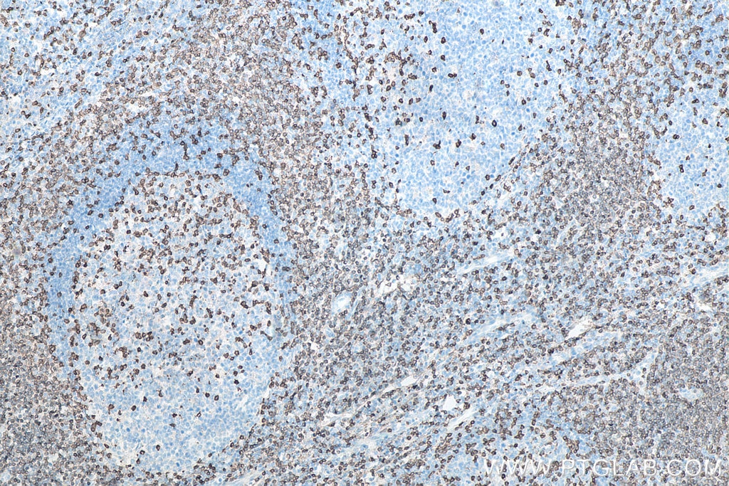 Immunohistochemical analysis of paraffin-embedded human tonsillitis tissue slide using KHC0013 (CD3 IHC Kit).