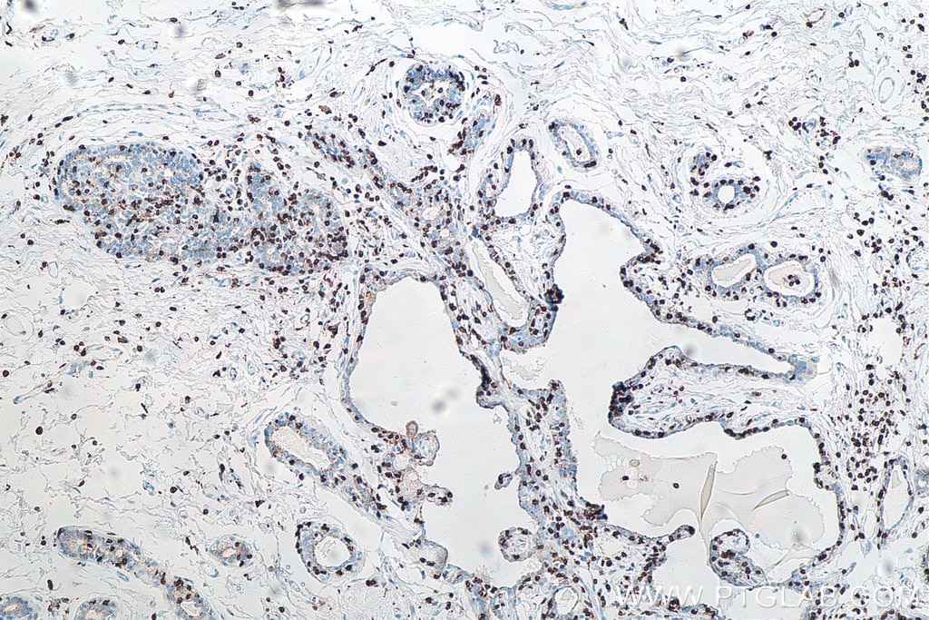 Immunohistochemical analysis of paraffin-embedded human breast cancer tissue slide using KHC0013 (CD3 IHC Kit)