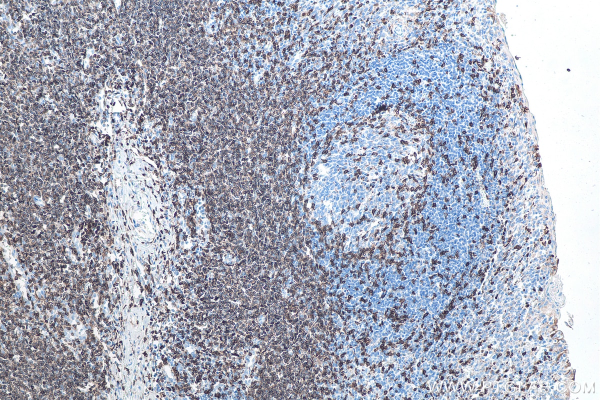 Immunohistochemical analysis of paraffin-embedded human tonsillitis tissue slide using KHC0013 (CD3 IHC Kit).