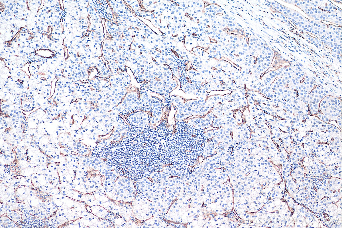 Immunohistochemical analysis of paraffin-embedded human liver cancer tissue slide using KHC0022 (CD31 IHC Kit).