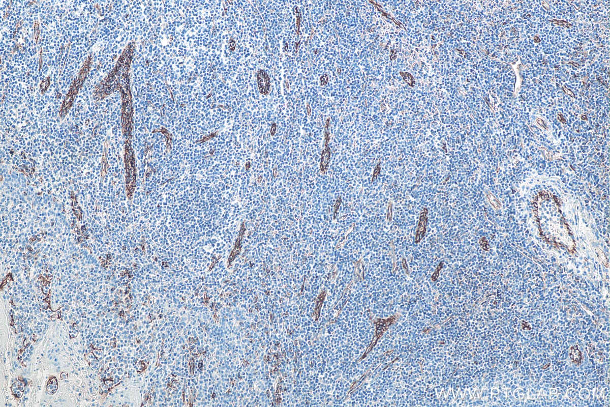 Immunohistochemical analysis of paraffin-embedded human tonsillitis tissue slide using KHC0022 (CD31 IHC Kit).