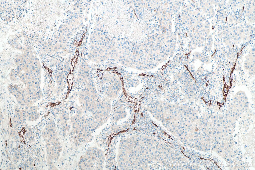 Immunohistochemical analysis of paraffin-embedded human breast cancer tissue slide using KHC0023 (CD34 IHC Kit).