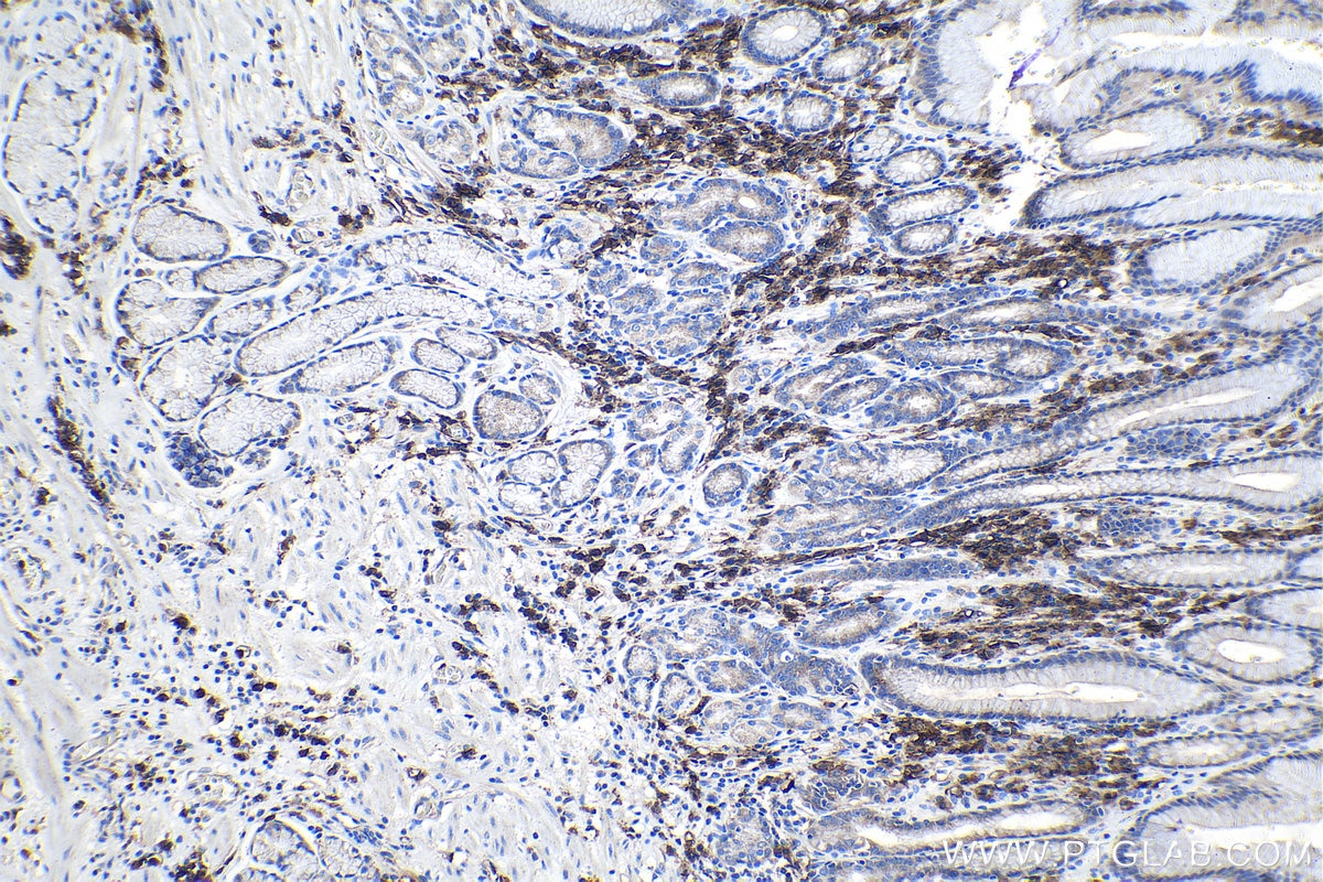 Immunohistochemical analysis of paraffin-embedded human stomach cancer tissue slide using KHC1119 (CD38 IHC Kit).