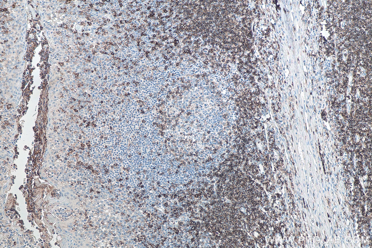 Immunohistochemical analysis of paraffin-embedded human tonsillitis tissue slide using KHC0015 (CD43 IHC Kit).