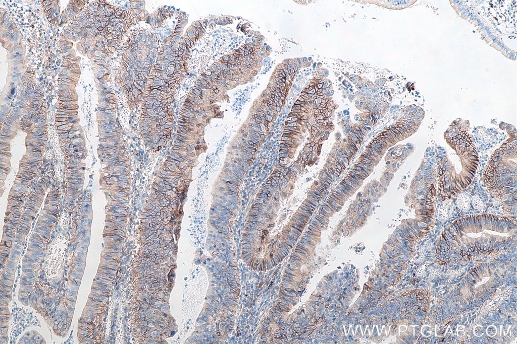 Immunohistochemical analysis of paraffin-embedded human colon cancer tissue slide using KHC0030 (CD44 IHC Kit).