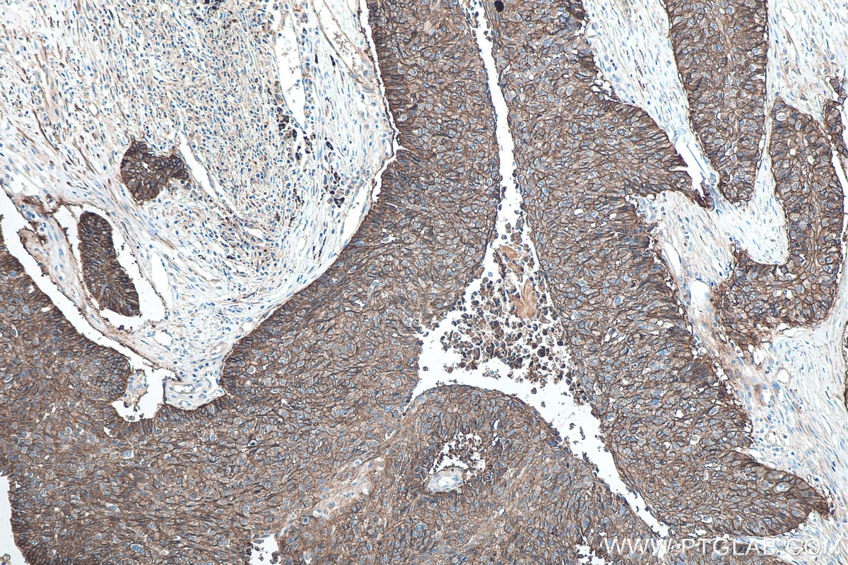 Immunohistochemical analysis of paraffin-embedded human lung cancer tissue slide using KHC0030 (CD44 IHC Kit).
