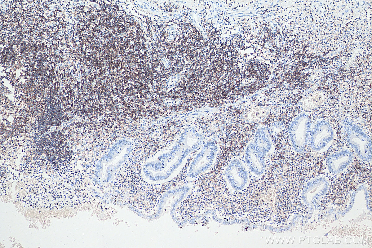 Immunohistochemical analysis of paraffin-embedded human appendicitis tissue slide using KHC0031 (CD45 IHC Kit).