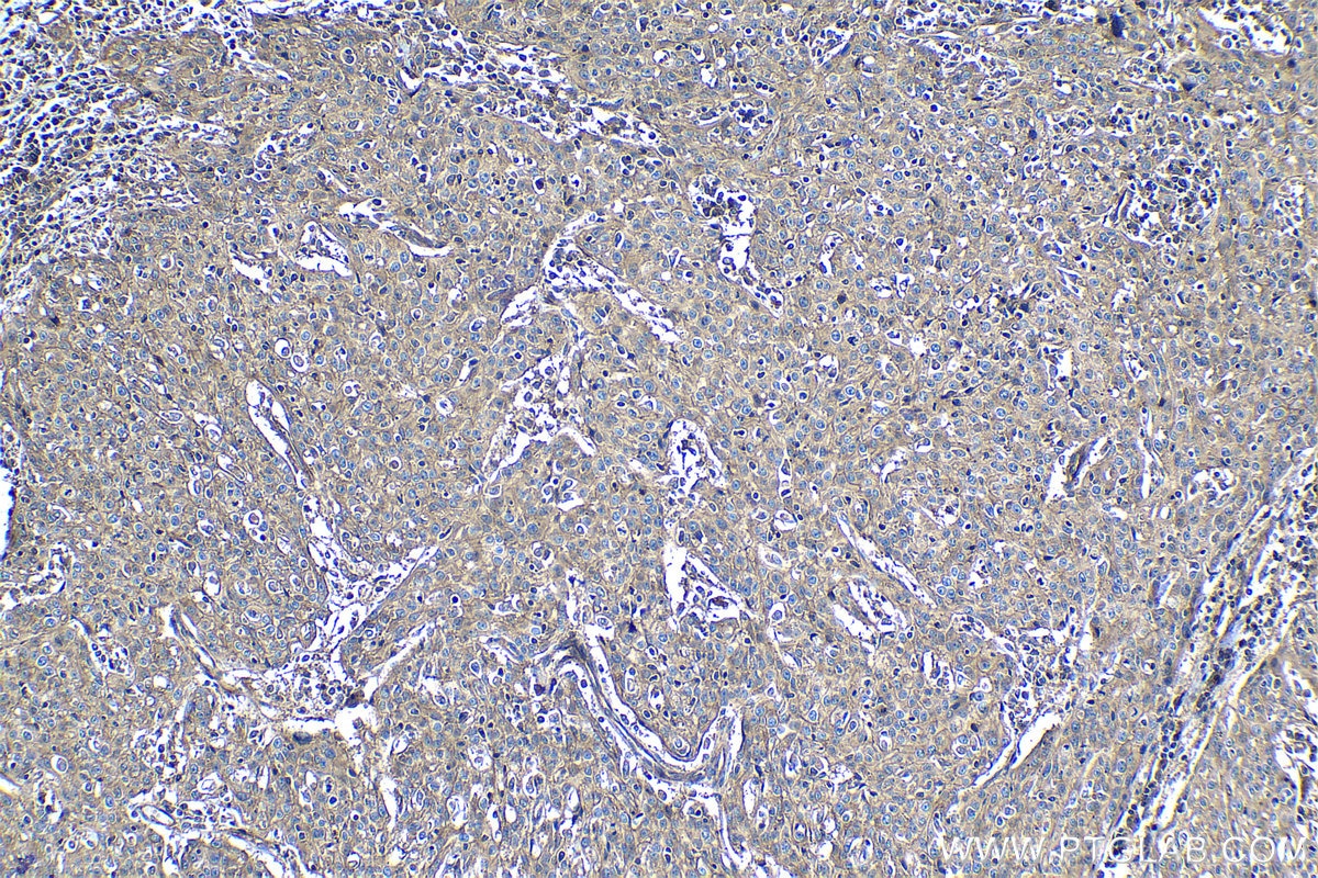 Immunohistochemical analysis of paraffin-embedded human cervical cancer tissue slide using KHC1235 (CD46 IHC Kit).