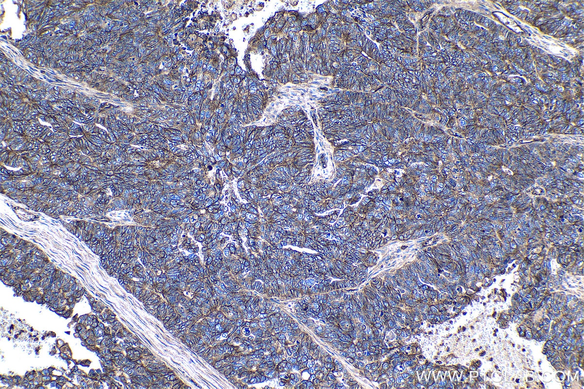 Immunohistochemical analysis of paraffin-embedded human ovary tumor tissue slide using KHC1235 (CD46 IHC Kit).