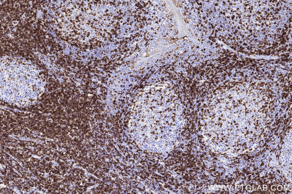 Immunohistochemical analysis of paraffin-embedded human tonsillitis tissue slide using KHC3311 (CD5 IHC Kit). Immunohistochemical analysis of paraffin-embedded human tonsillitis tissue slide using KHC3311 (CD5 IHC Kit).