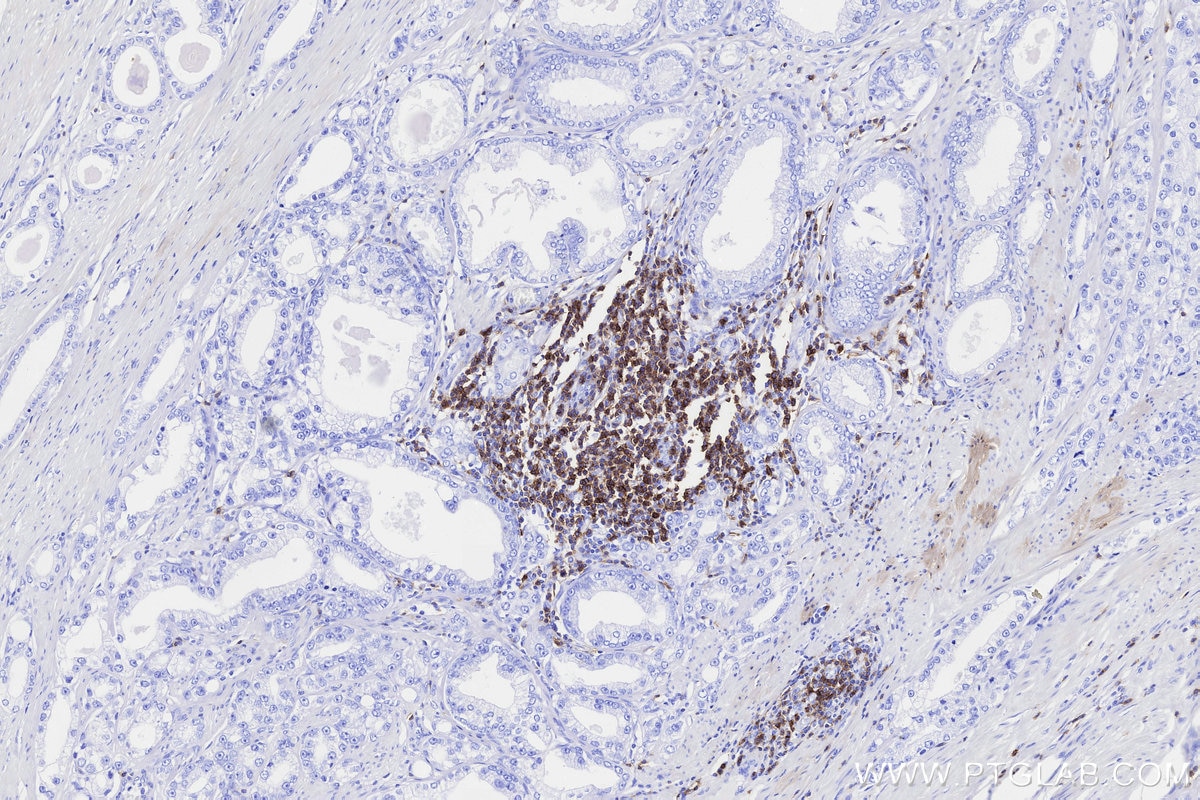 Immunohistochemical analysis of paraffin-embedded human prostate cancer tissue slide using KHC3311 (CD5 IHC Kit). Immunohistochemical analysis of paraffin-embedded human prostate cancer tissue slide using KHC3311 (CD5 IHC Kit).