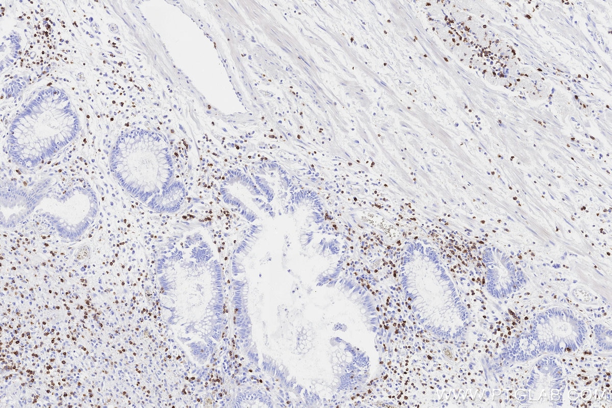 Immunohistochemical analysis of paraffin-embedded human rectal cancer tissue slide using KHC3311 (CD5 IHC Kit). Immunohistochemical analysis of paraffin-embedded human rectal cancer tissue slide using KHC3311 (CD5 IHC Kit).