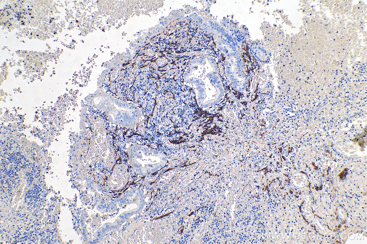 Immunohistochemical analysis of paraffin-embedded human appendicitis tissue slide using KHC0734 (CD56/NCAM1 IHC Kit).