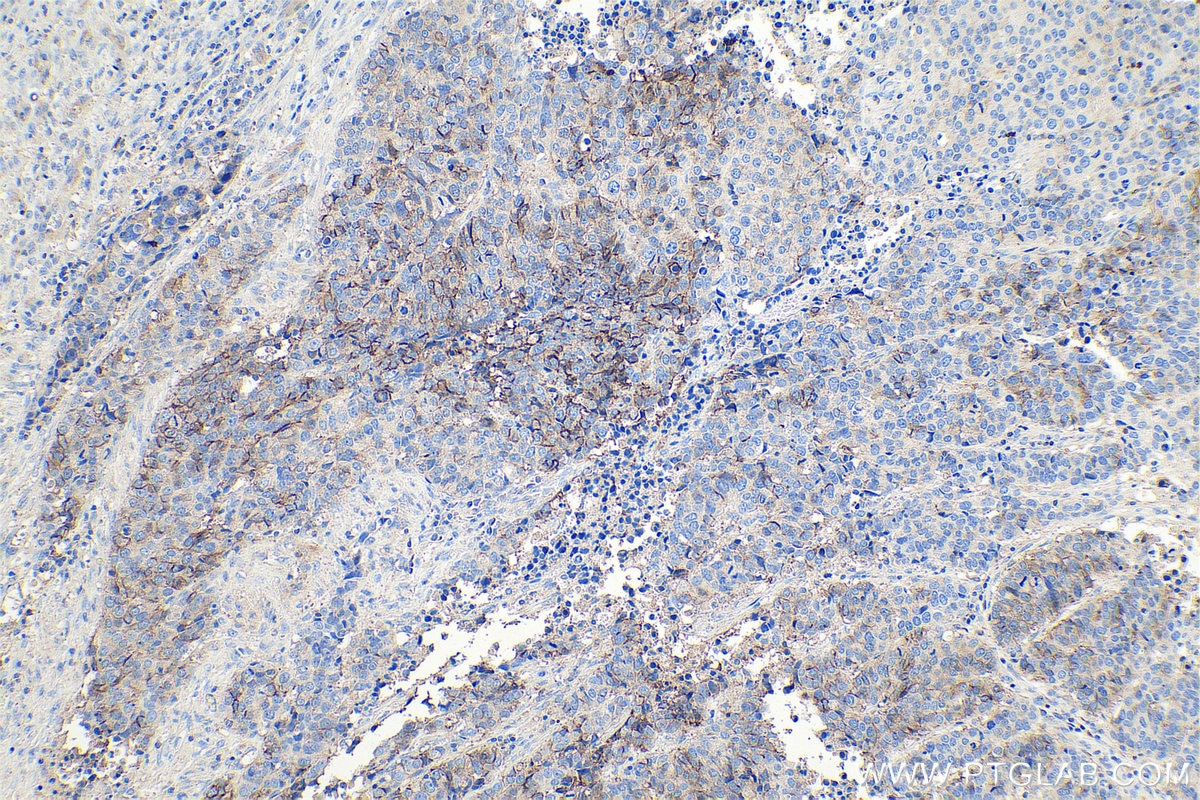 Immunohistochemical analysis of paraffin-embedded human stomach cancer tissue slide using KHC0734 (CD56/NCAM1 IHC Kit).