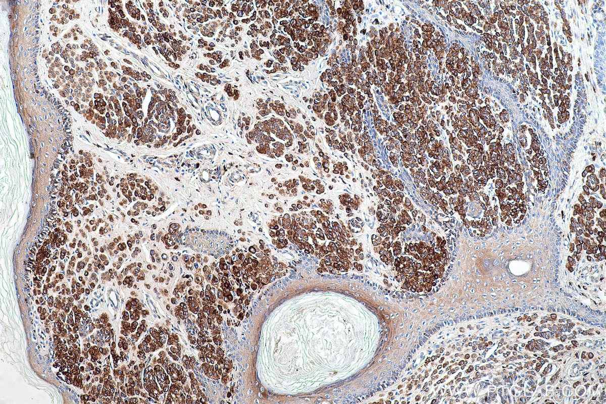 Immunohistochemical analysis of paraffin-embedded human malignant melanoma tissue slide using KHC0722 (CD63 IHC Kit).