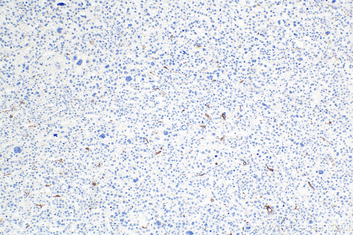 Immunohistochemical analysis of paraffin-embedded human liver cancer tissue slide using KHC0006 (CD68 IHC Kit).