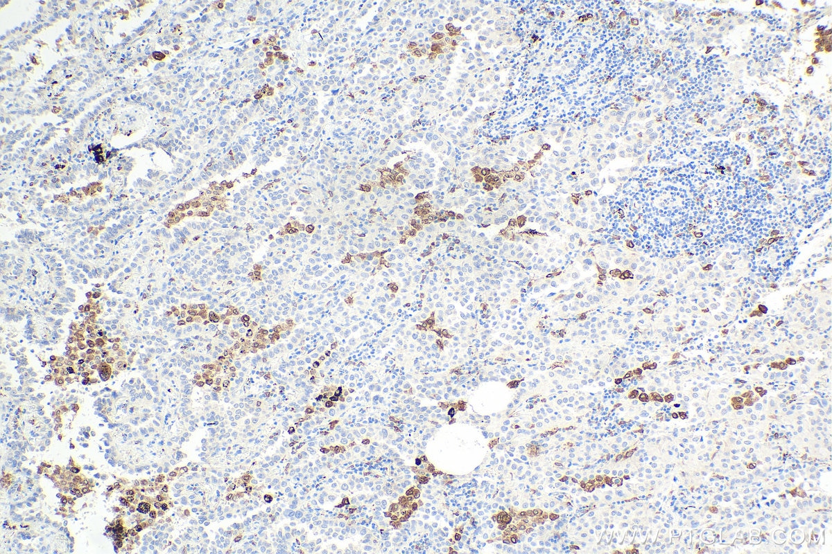Immunohistochemical analysis of paraffin-embedded human lung cancer tissue slide using KHC0006 (CD68 IHC Kit).