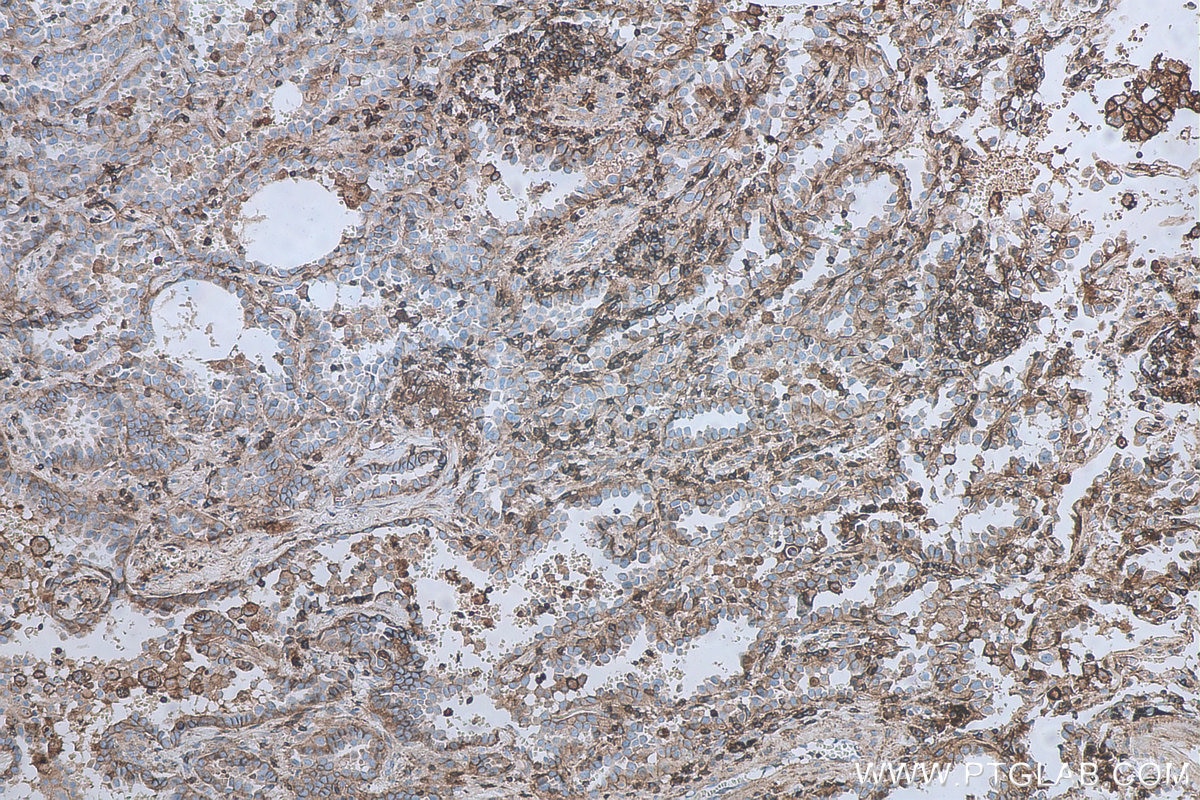 Immunohistochemical analysis of paraffin-embedded human lung cancer tissue slide using KHC0496 (CD71 IHC Kit).