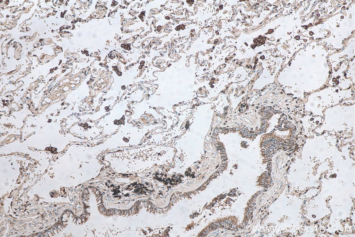 Immunohistochemical analysis of paraffin-embedded human lung cancer(NAT) tissue slide using KHC0496 (CD71 IHC Kit).