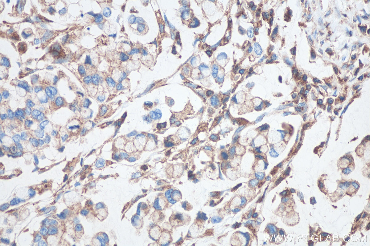 Immunohistochemical analysis of paraffin-embedded human colon cancer tissue slide using KHC0496 (CD71 IHC Kit).