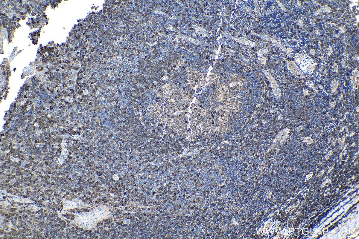 Immunohistochemical analysis of paraffin-embedded human tonsillitis tissue slide using KHC1554 (CD79A IHC Kit).