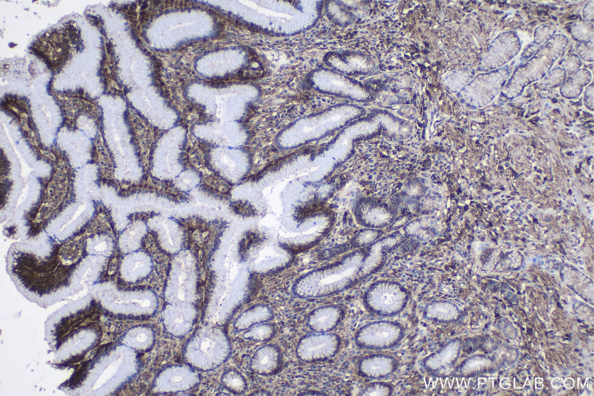 Immunohistochemical analysis of paraffin-embedded human stomach cancer tissue slide using KHC1120 (CD9 IHC Kit).