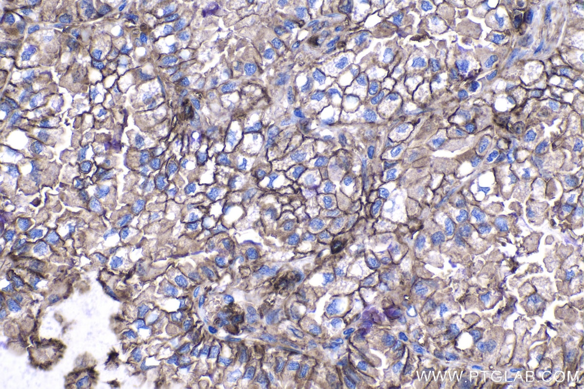 Immunohistochemical analysis of paraffin-embedded human lung cancer tissue slide using KHC1120 (CD9 IHC Kit).