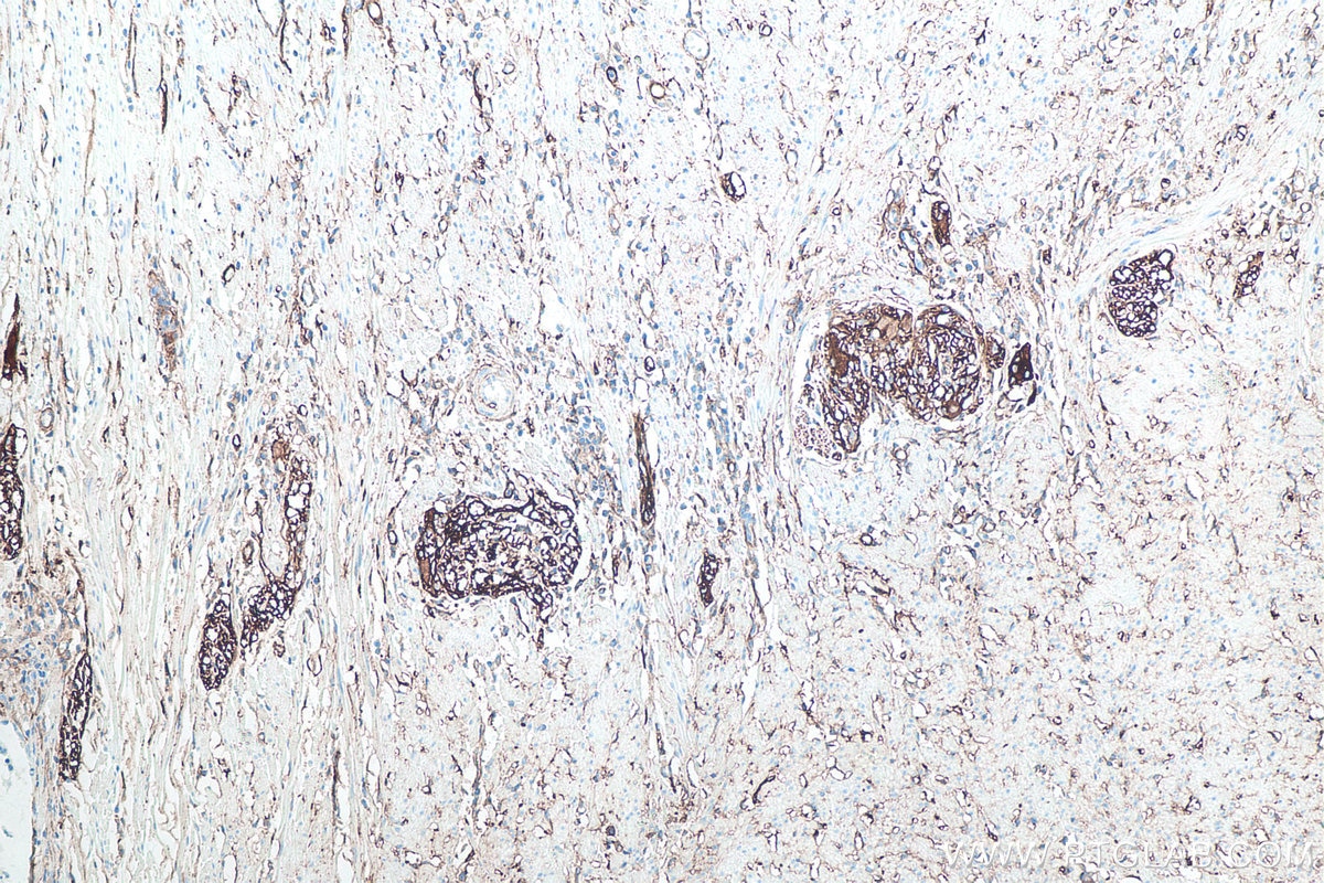 Immunohistochemical analysis of paraffin-embedded human colon cancer tissue slide using KHC0081 (CD90 IHC Kit).